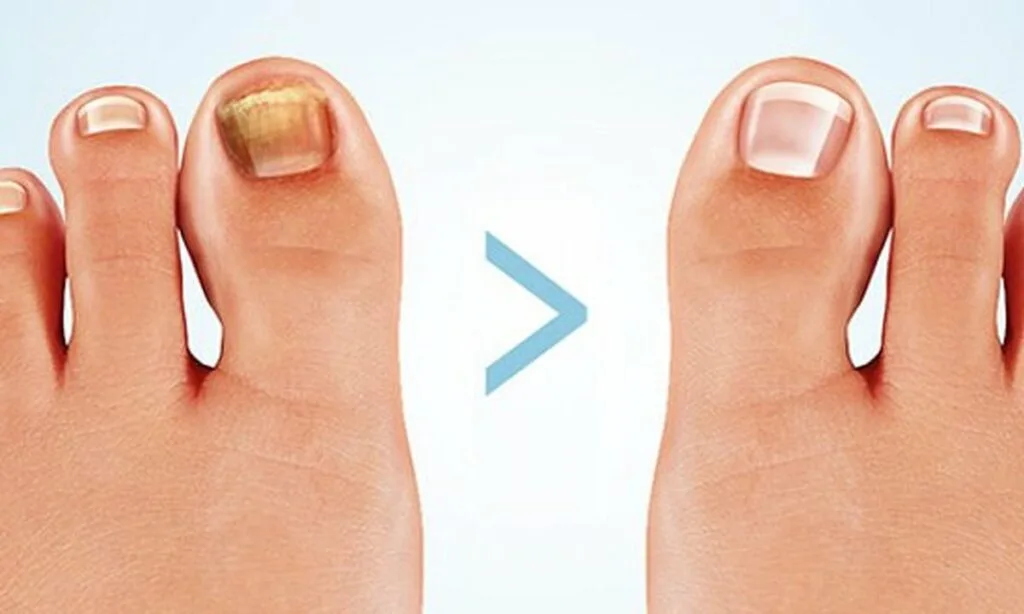 Behandling af skaldede negle